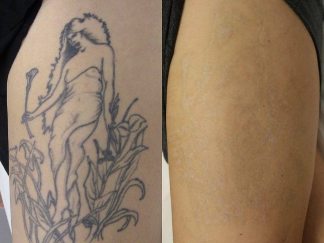 laser tattoo removal Archives - Sama MedSpa